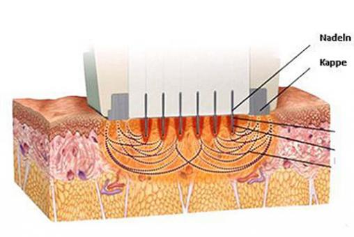 Hautstraffung mittels thermisches Radiofrequenzsystem